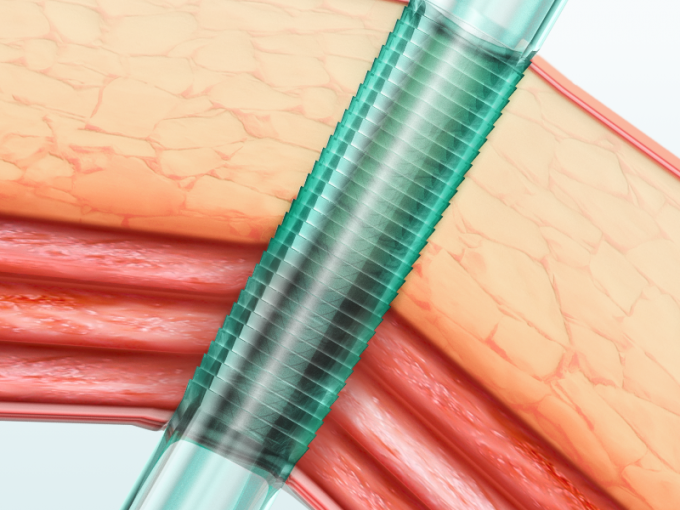 Μίας χρήσης κάννουλα Trocar οργάνων Laparoscopic με τη λεπίδα 0