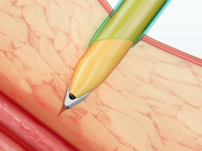 Μίας χρήσης κάννουλα Trocar οργάνων Laparoscopic με τη λεπίδα 1