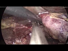 Application of Ultrasonic Scalpel | Surgsci
